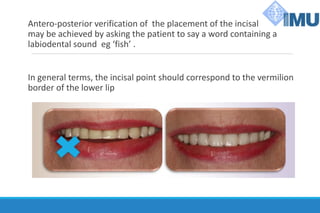 Antero-posterior verification of the placement of the incisal point
may be achieved by asking the patient to say a word containing a
labiodental sound eg ‘fish’ .
In general terms, the incisal point should correspond to the vermilion
border of the lower lip
 