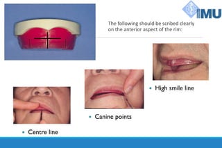 The following should be scribed clearly
on the anterior aspect of the rim:
 Centre line
 High smile line
 Canine points
 