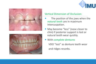Vertical Dimension of Occlusion:
 The position of the jaws when the
natural teeth are in maximum
intercuspation.
 May become “less” (nose closer to
chin) if posterior support is lost or
natural teeth wear quickly.
 With complete dentures
VDO “lost” as denture teeth wear
and ridges resorbs.
 