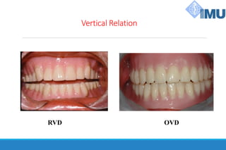 Vertical Relation
RVD OVD
 