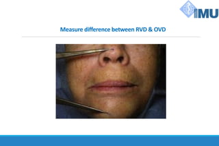 Measure difference between RVD & OVD
 