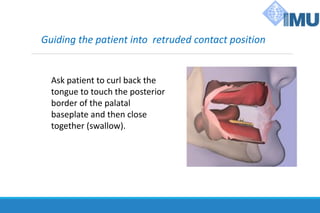Guiding the patient into retruded contact position
Ask patient to curl back the
tongue to touch the posterior
border of the palatal
baseplate and then close
together (swallow).
 