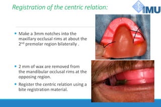 Registration of the centric relation:
 Make a 3mm notches into the
maxillary occlusal rims at about the
2nd premolar region bilaterally .
 2 mm of wax are removed from
the mandibular occlusal rims at the
opposing region.
 Register the centric relation using a
bite registration material.
 