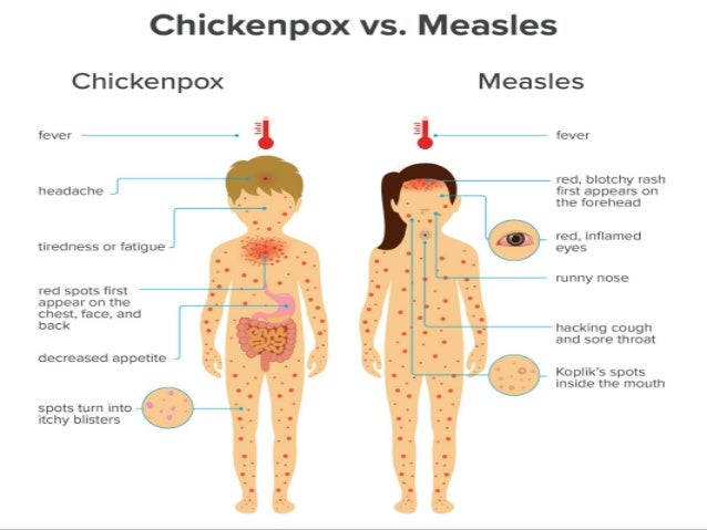 images Chicken Pox Rubella Rash Vs Measles Rash measles mumps rubella chicken pox