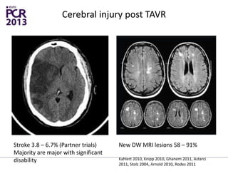 Cerebral injury post TAVR
Stroke 3.8 – 6.7% (Partner trials)
Majority are major with significant
disability
New DW MRI lesions 58 – 91%
Kahlert 2010, Knipp 2010, Ghanem 2011, Astarci
2011, Stolz 2004, Arnold 2010, Rodes 2011
 