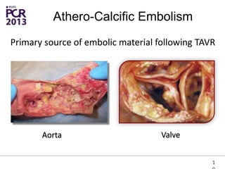 Athero-Calcific Embolism
Primary source of embolic material following TAVR
Aorta Valve
1
 