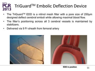 • The TriGuardTM EDD is a nitinol mesh filter with a pore size of 250μm
designed deflect cerebral emboli while allowing maximal blood flow.
• The filter’s positioning across all 3 cerebral vessels is maintained by
stabilizers.
• Delivered via 9 Fr sheath from femoral artery
EDD in position
11
TriGuardTM Embolic Deflection Device
 