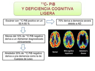 Escáner con 11C PiB positivo en un    70% deriva a demencia severa
           50 A 60 %                          debido a AD




Menos del 10% de 11C PiB negativo
deriva a un Alzheimer diagnosticado
            clínicamente



Alrededor 20% de 11C PiB negativo
deriva a una demencia como la de
         Cuerpos de Lewy
 