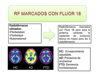Radiofármacos   Radiofármacos    marcados
utilizados:     con Fluor 18 para para la
•Florbetaben    proteína    amiloide,    la
•Florbetapir    captación   de    sustancia
•flutemetamol   blanca en mayor para los 3
                radiofármacos.


                HC: Envejecimiento
                saludable.
                AD: Presencia de
                anzheimer
                FTD: Demencia
                frontotemporal
 