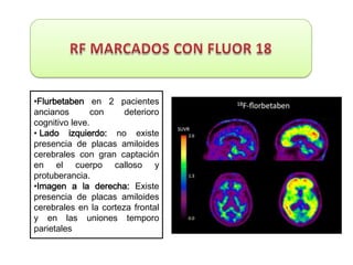 •Flurbetaben en 2 pacientes
ancianos       con     deterioro
cognitivo leve.
• Lado izquierdo: no existe
presencia de placas amiloides
cerebrales con gran captación
en el cuerpo calloso y
protuberancia.
•Imagen a la derecha: Existe
presencia de placas amiloides
cerebrales en la corteza frontal
y en las uniones temporo
parietales
 