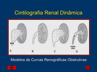 Cintilografia Renal Dinâmica Modelos de Curvas Renográficas Obstrutivas 