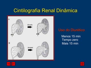 Cintilografia Renal Dinâmica Uso do Diurético Menos 15 min Tempo zero Mais 15 min 