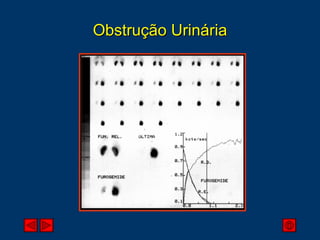 Obstrução Urinária 