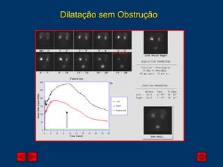 Dilatação sem Obstrução 