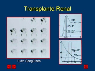Transplante Renal Fluxo Sangüíneo 