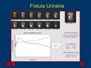 Fístula Urinária 