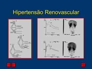 Hipertensão Renovascular 