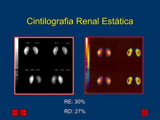 Cintilografia Renal Estática RE: 30% RD: 27% 