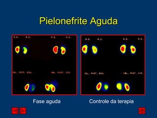 Pielonefrite Aguda Fase aguda Controle da terapia 