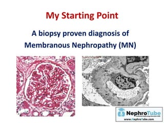 My Starting Point
A biopsy proven diagnosis of
Membranous Nephropathy (MN)
 