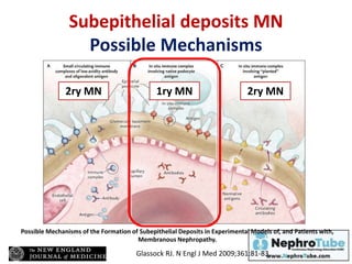 Subepithelial deposits MN
Possible Mechanisms
Glassock RJ. N Engl J Med 2009;361:81-83.
Possible Mechanisms of the Formation of Subepithelial Deposits in Experimental Models of, and Patients with,
Membranous Nephropathy.
1ry MN2ry MN 2ry MN
 