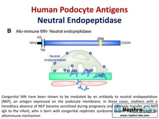 Congenital MN have been shown to be mediated by an antibody to neutral endopeptidase
(NEP), an antigen expressed on the podocyte membrane. In these cases, mothers with a
hereditary absence of NEP become sensitized during pregnancy and passively transfer anti-NEP
IgG to the infant, who is born with congenital nephrotic syndrome caused by MN through an
alloimmune mechanism
Human Podocyte Antigens
Neutral Endopeptidase
 