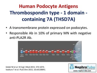 Human Podocyte Antigens
Thrombospondin type - 1 domain -
containing 7A (THSD7A)
• A transmembrane protein expressed on podocytes.
• Responsible Ab in 10% of primary MN with negative
anti-PLA2R Ab.
Gödel M et al. N Engl J Med 2015; 372:1073.
Iwakura T et al. PLoS One 2015; 10:e0138841.
 