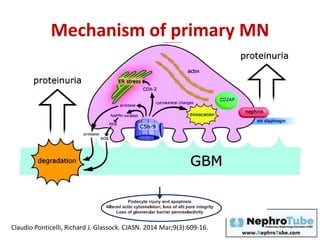 Mechanism of primary MN
Claudio Ponticelli, Richard J. Glassock. CJASN. 2014 Mar;9(3):609-16.
 