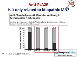 Anti-PLA2R
Is it only related to Idiopathic MN?
J Am Soc Nephrol 22: 1137–1143, 2011.
 