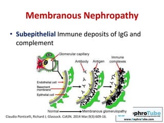 Membranous Nephropathy
• Subepithelial Immune deposits of IgG and
complement
Claudio Ponticelli, Richard J. Glassock. CJASN. 2014 Mar;9(3):609-16.
 
