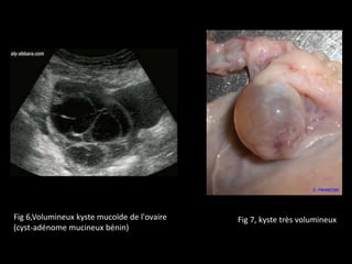 Fig 7, kyste très volumineuxFig 6,Volumineux kyste mucoïde de l'ovaire
(cyst-adénome mucineux bénin)
 