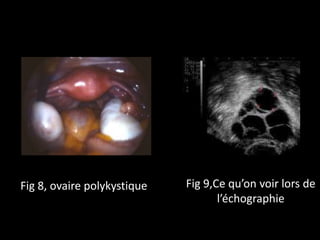 Fig 8, ovaire polykystique Fig 9,Ce qu’on voir lors de
l’échographie
 