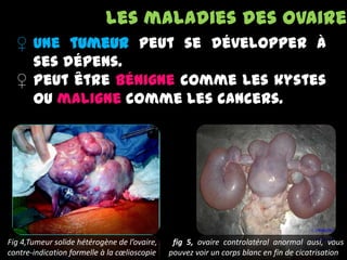 ♀ Une tumeur peut se développer à
ses dépens.
♀ Peut être bénigne comme les kystes
ou maligne comme les cancers.
Les maladies des ovaires
Fig 4,Tumeur solide hétérogène de l’ovaire,
contre-indication formelle à la cœlioscopie
fig 5, ovaire controlatéral anormal ausi, vous
pouvez voir un corps blanc en fin de cicatrisation
 