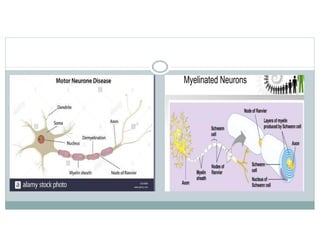 Motor Neuron Disease : complete presentation | PPTX