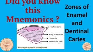 Zones of
Enamel
and
Dentinal
Caries
Did you know
this
Mnemonics ?
 