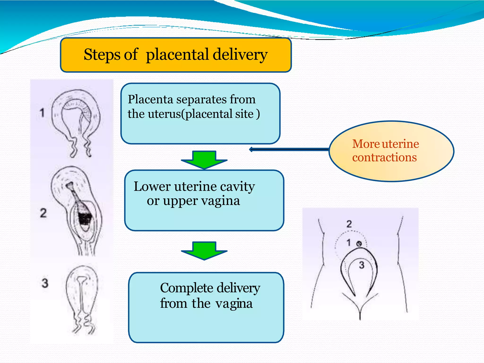 the uterus(placental site)
Placenta separates from
the uterus(placental site )
Lower uterine cavity
or upper vagina
Complete delivery
from the vagina
Moreuterine
contractions
Steps of placental delivery
 