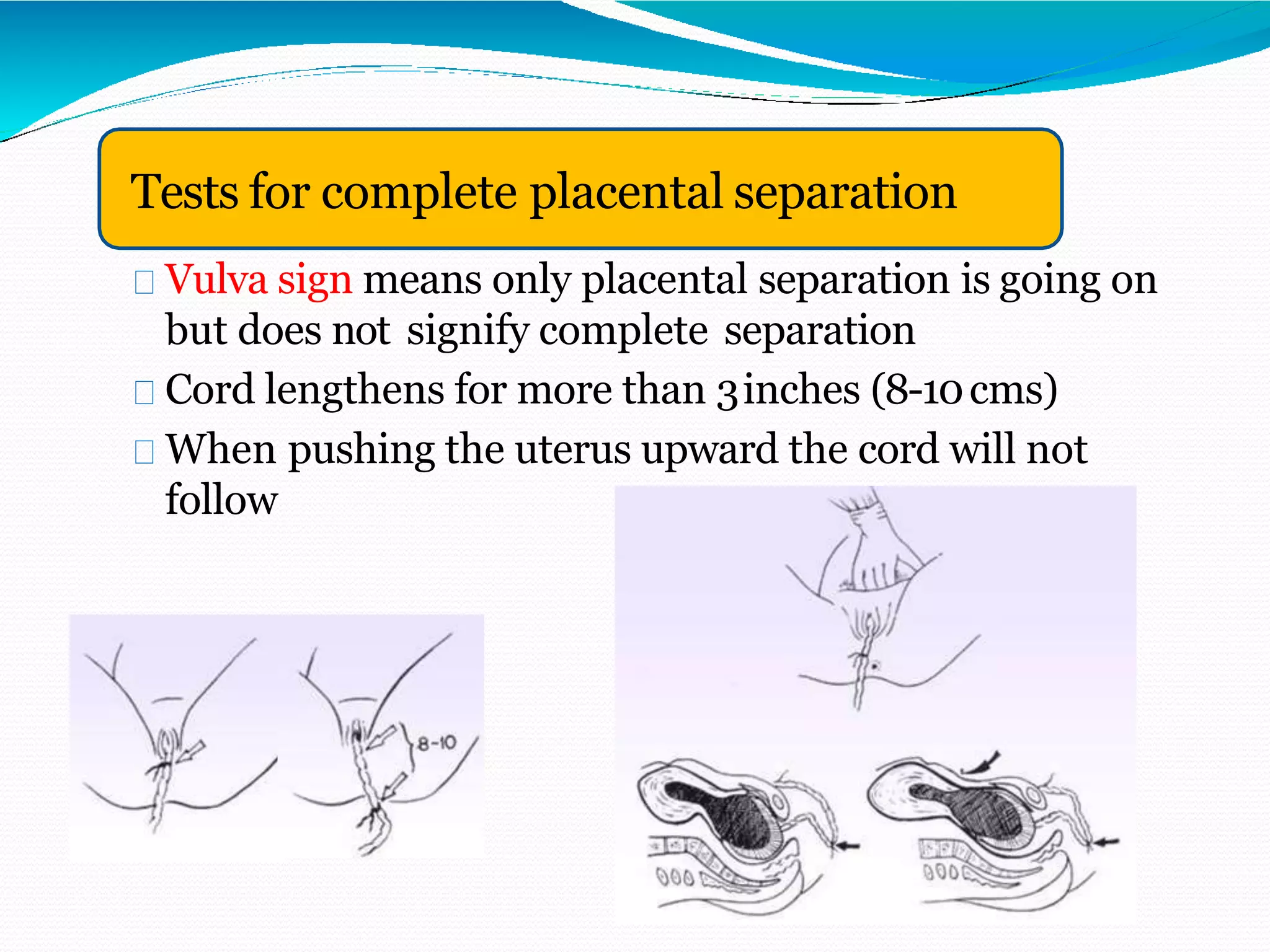 Vulva sign means only placental separation is going on
but does not signify complete separation
Cord lengthens for more than 3inches (8-10cms)
When pushing the uterus upward the cord will not
follow
Tests for complete placental separation
 