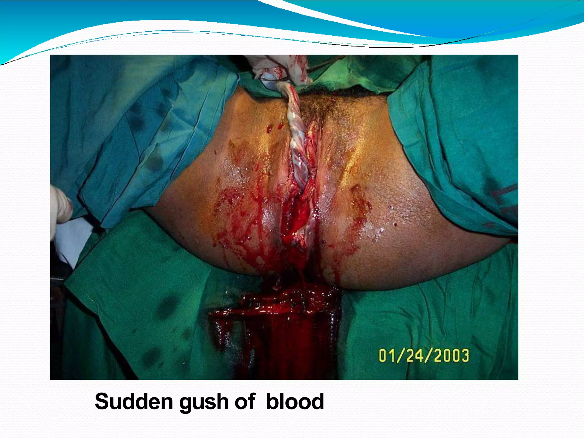 Sudden gush of blood
 