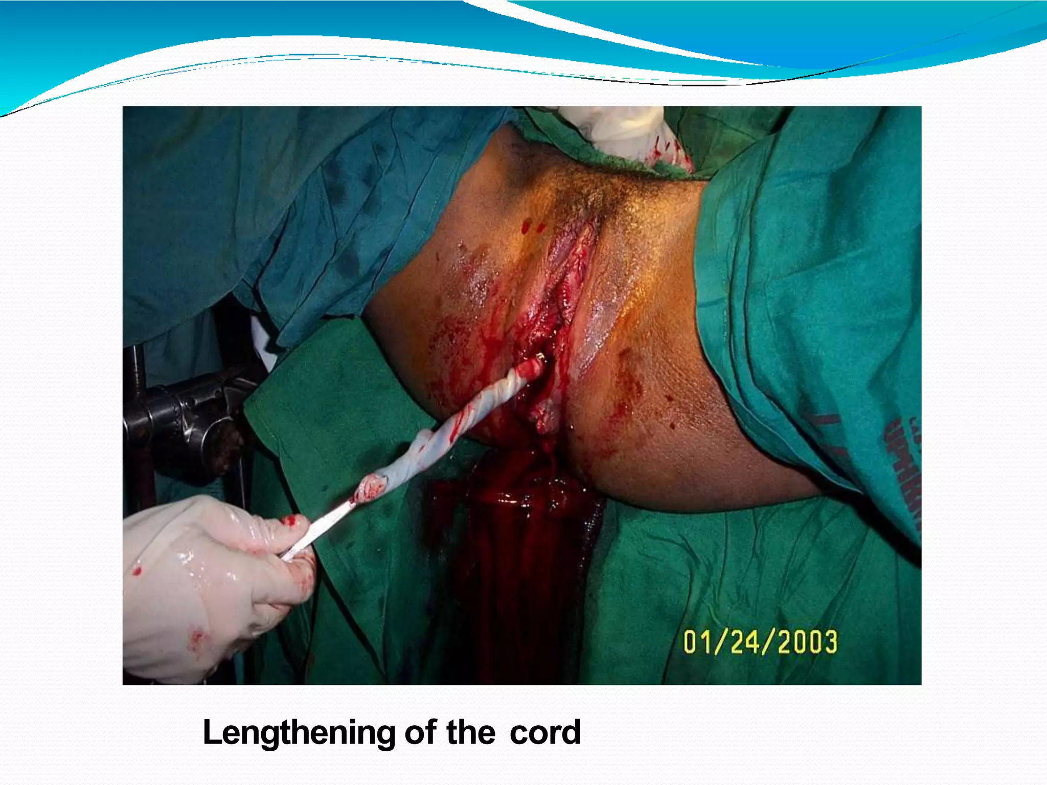 Lengthening of the cord
 