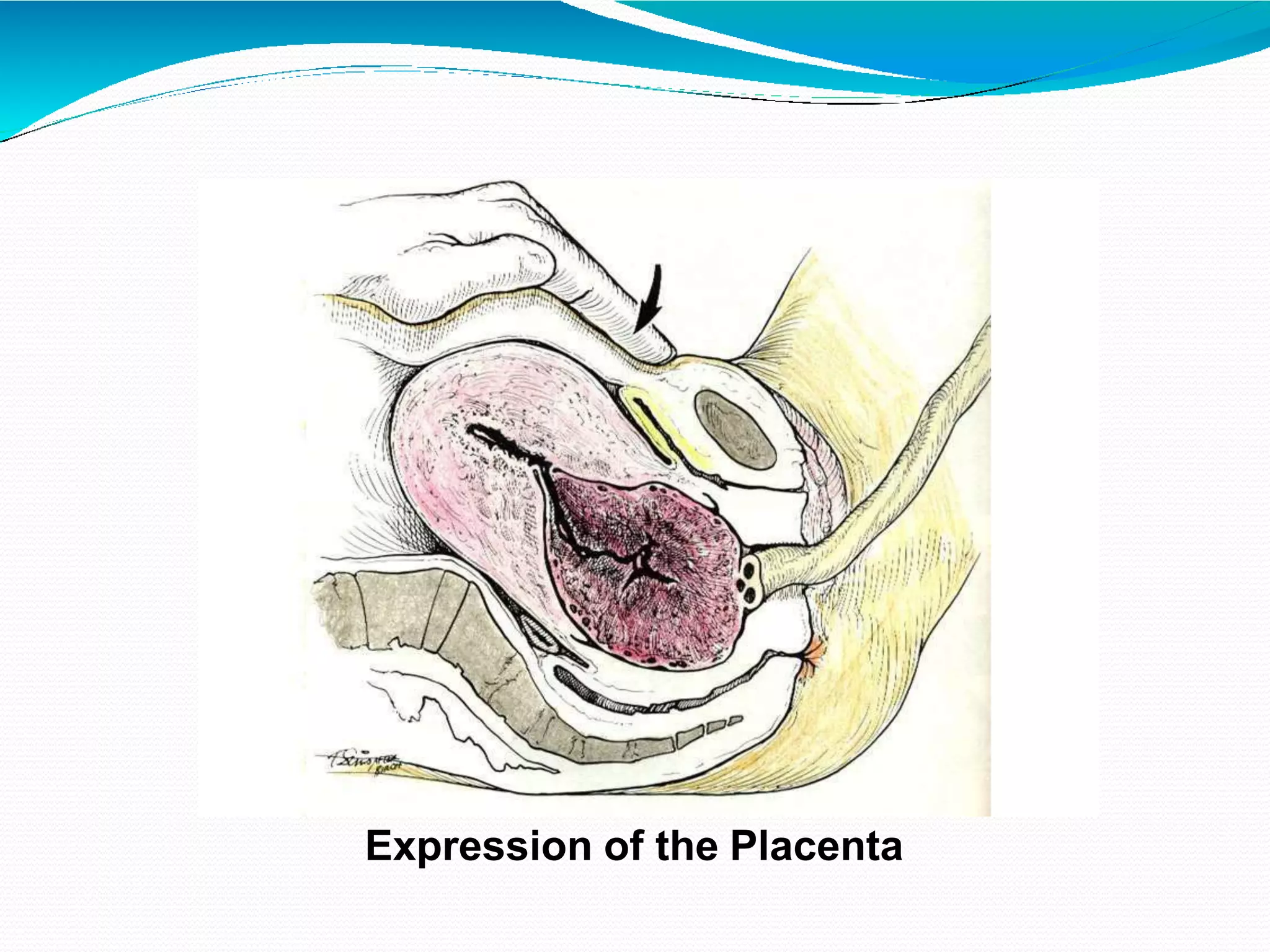 Expression of the Placenta
 