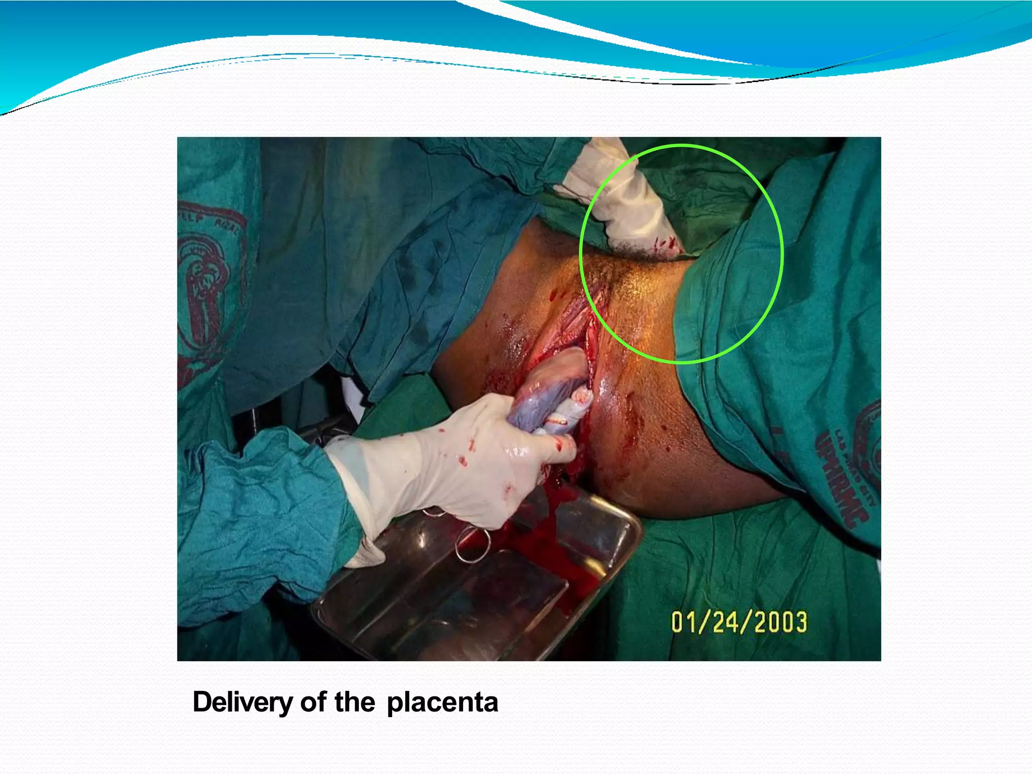 Delivery of the placenta
 