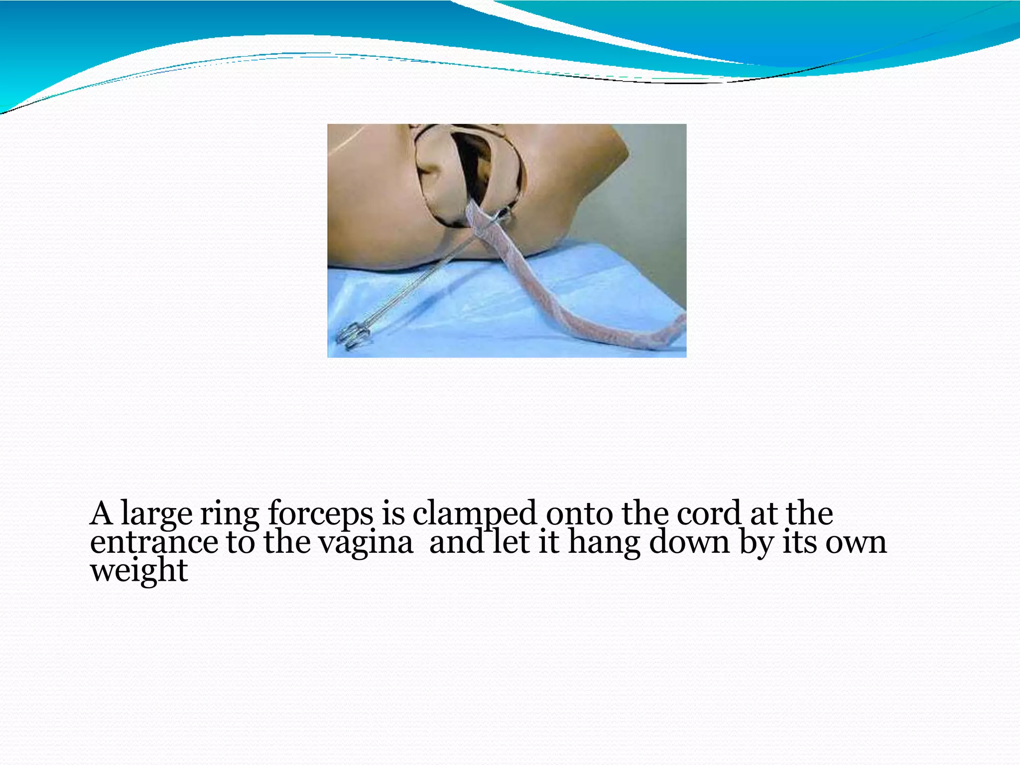 A large ring forceps is clamped onto the cord at the
entrance to the vagina and let it hang down by its own
weight
 