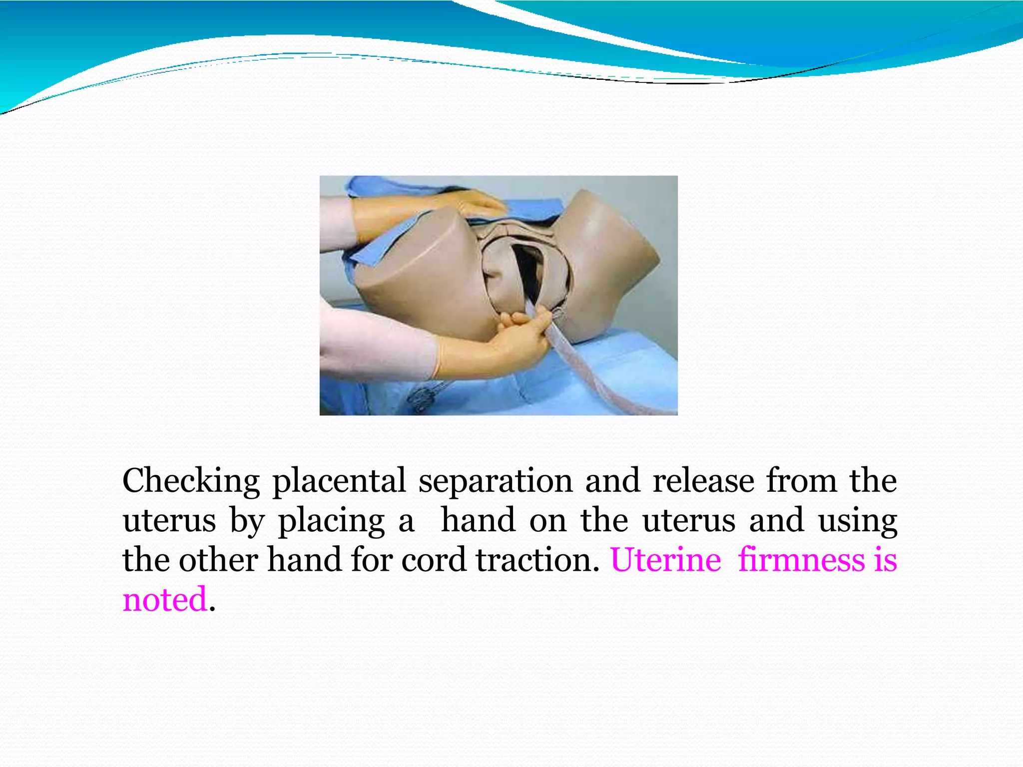 Checking placental separation and release from the
uterus by placing a hand on the uterus and using
the other hand for cord traction. Uterine firmness is
noted.
 