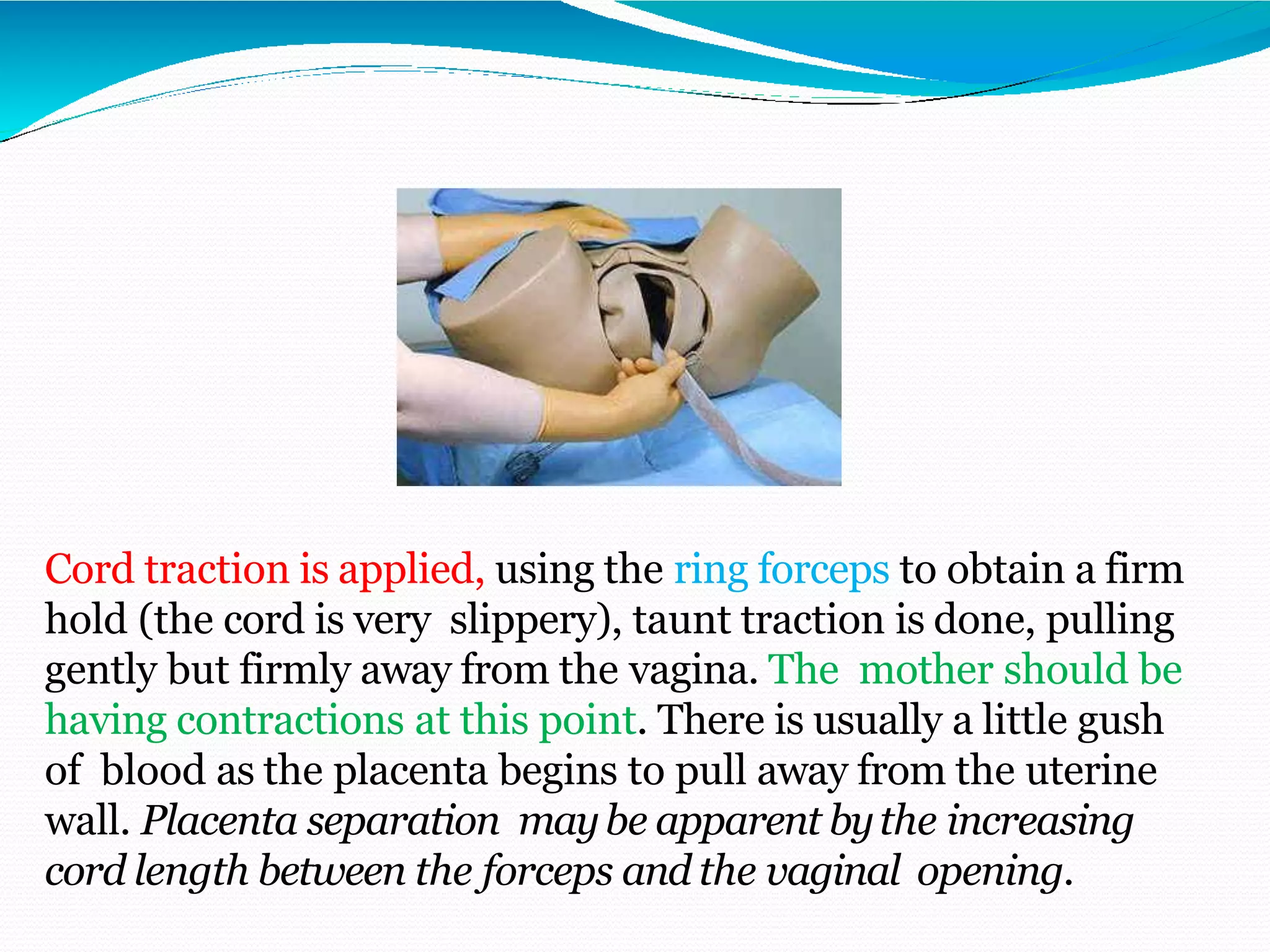 Cord traction is applied, using the ring forceps to obtain a firm
hold (the cord is very slippery), taunt traction is done, pulling
gently but firmly away from the vagina. The mother should be
having contractions at this point. There is usually a little gush
of blood as the placenta begins to pull away from the uterine
wall. Placenta separation maybe apparent bythe increasing
cord length between the forceps and the vaginal opening.
 