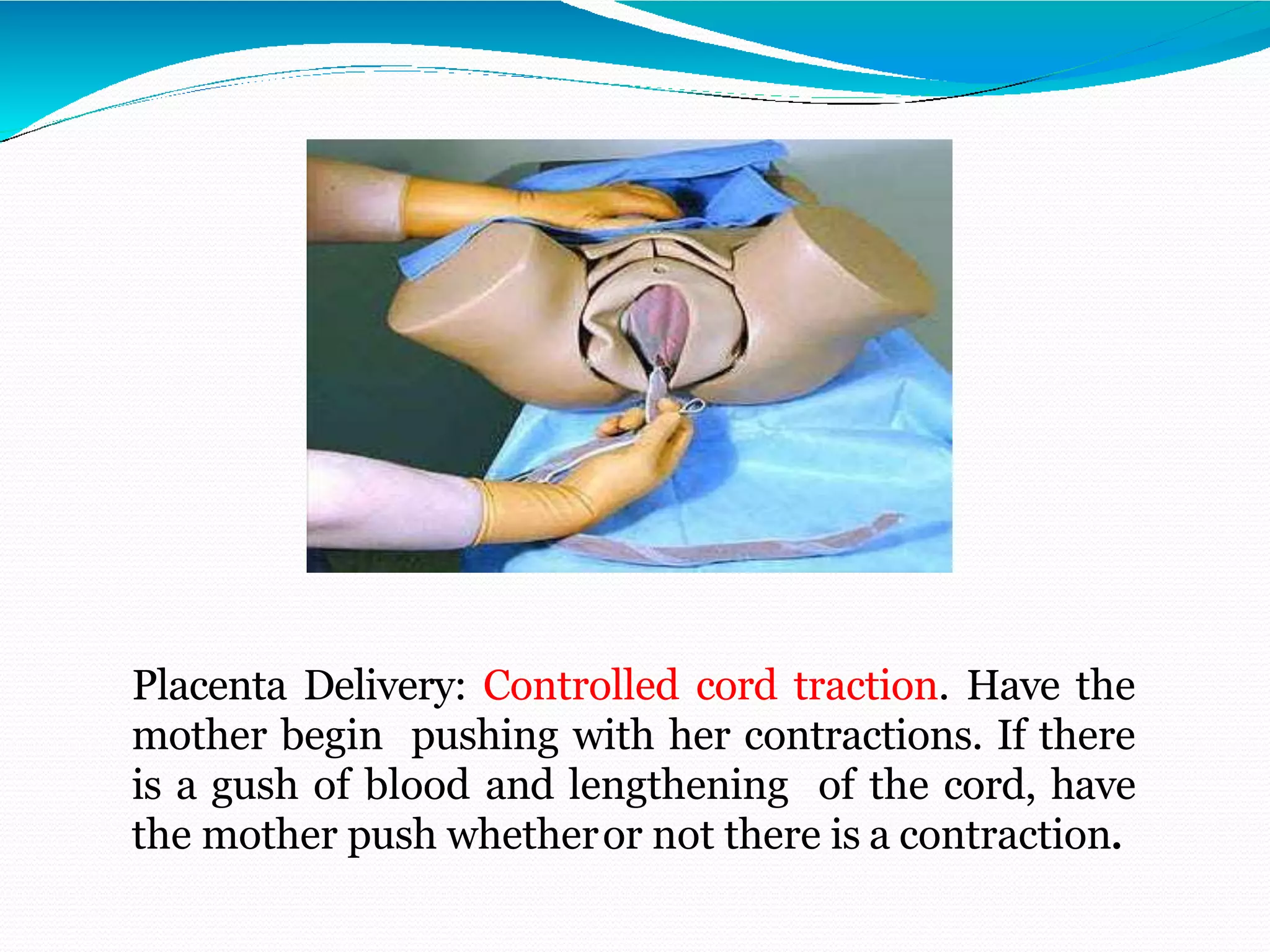 Placenta Delivery: Controlled cord traction. Have the
mother begin pushing with her contractions. If there
is a gush of blood and lengthening of the cord, have
the mother push whetheror not there is a contraction.
 