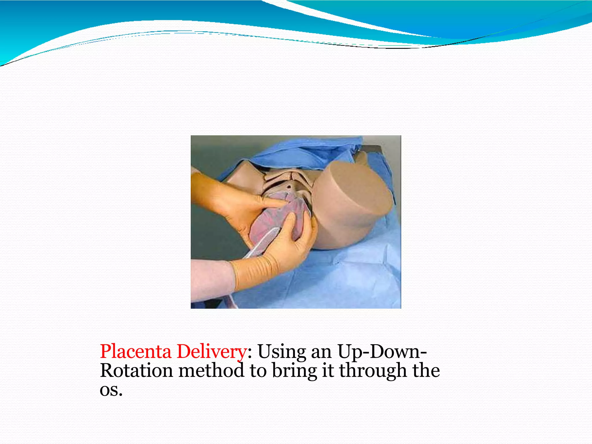 Placenta Delivery: Using an Up-Down-
Rotation method to bring it through the
os.
 