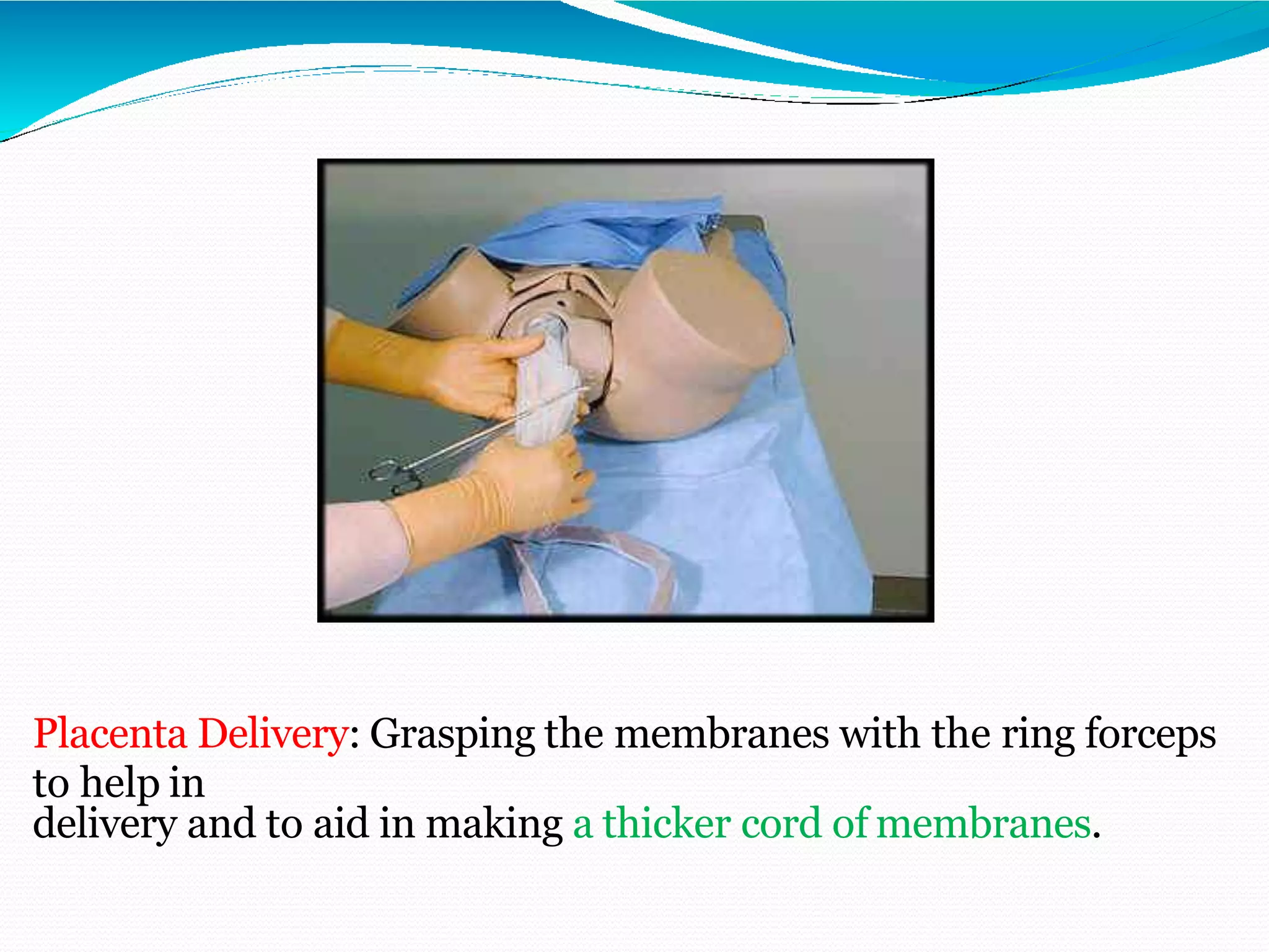 Placenta Delivery: Grasping the membranes with the ring forceps
to help in
delivery and to aid in making a thicker cord of membranes.
 