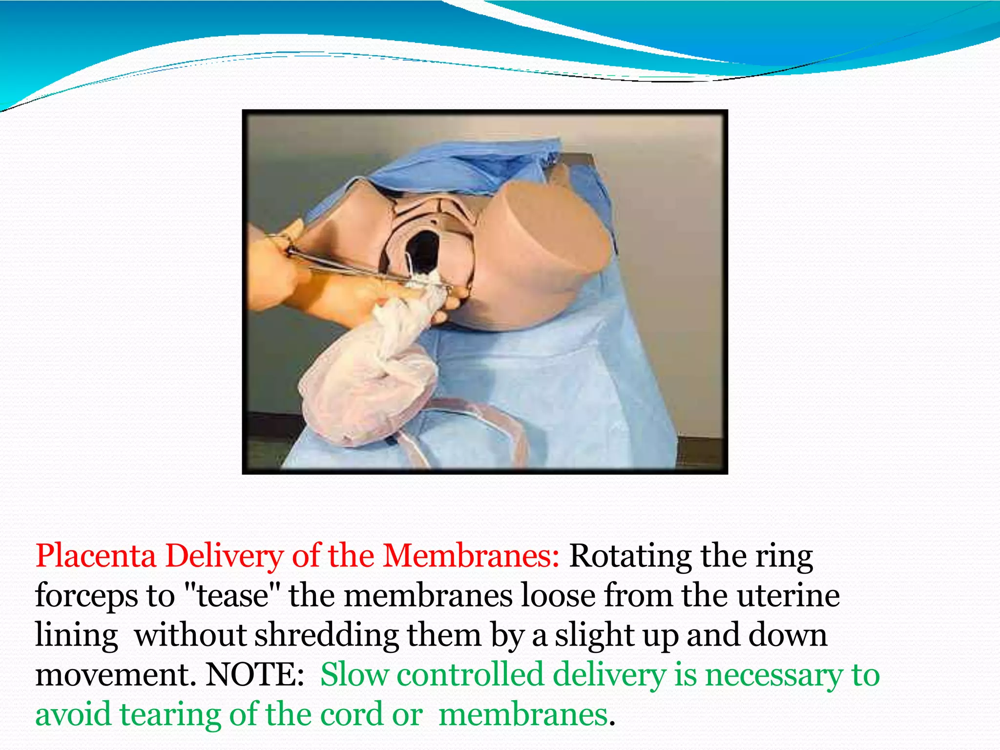 Placenta Delivery of the Membranes: Rotating the ring
forceps to "tease" the membranes loose from the uterine
lining without shredding them by a slight up and down
movement. NOTE: Slow controlled delivery is necessary to
avoid tearing of the cord or membranes.
 