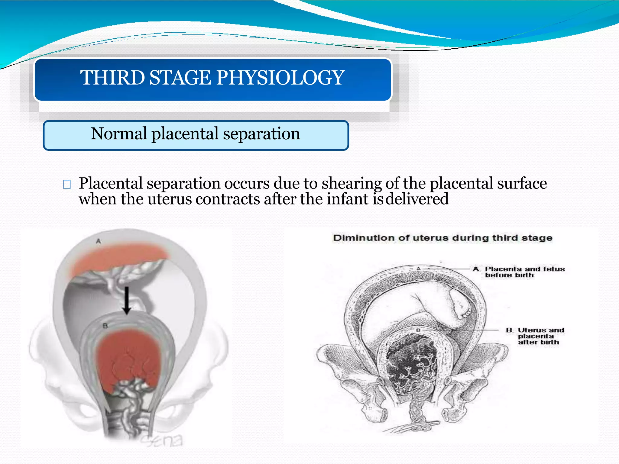 THIRD STAGE PHYSIOLOGY
Normal placental separation
Placental separation occurs due to shearing of the placental surface
when the uterus contracts after the infant isdelivered
 