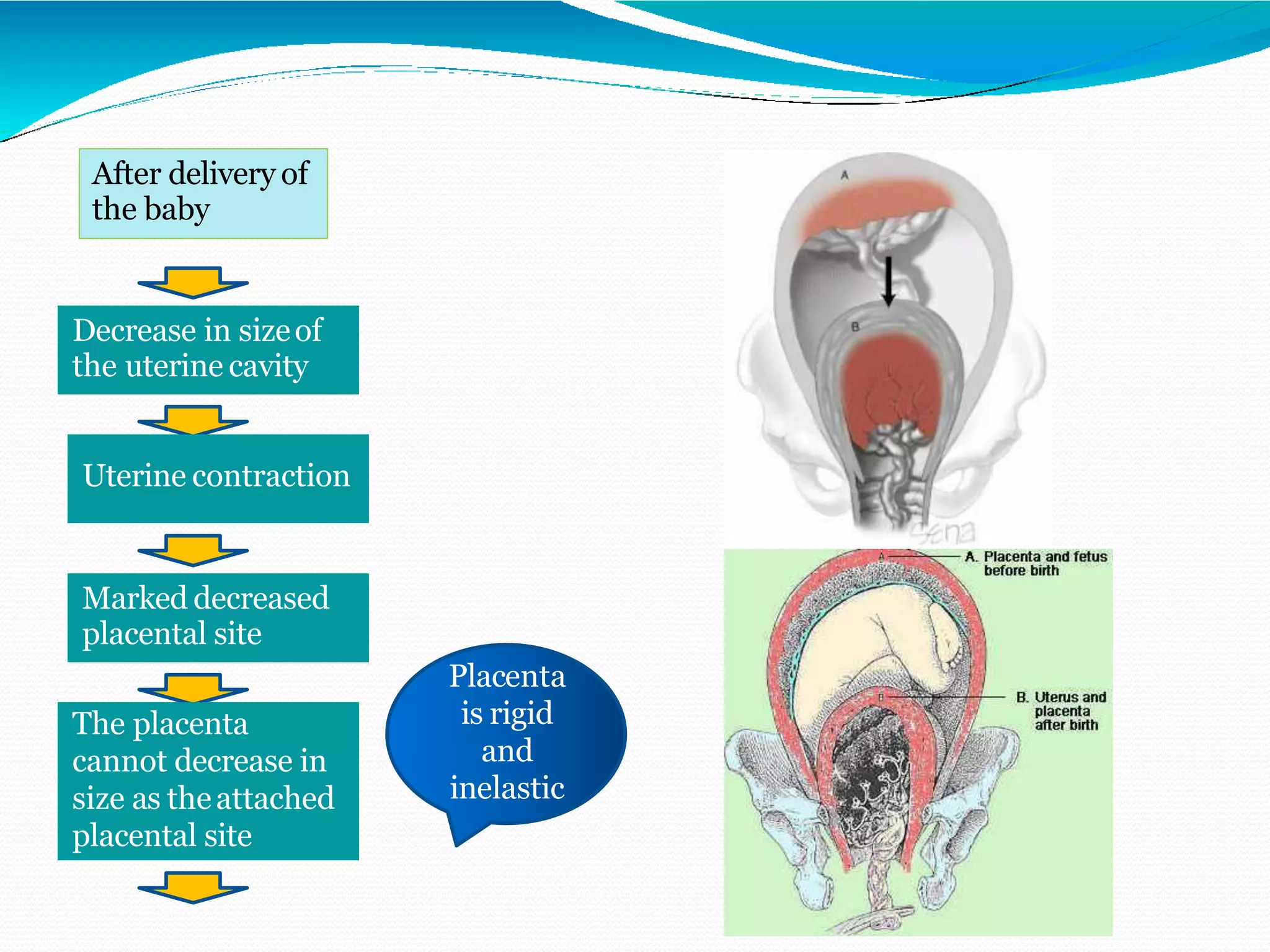 After delivery of
the baby
Decrease in sizeof
the uterine cavity
Uterinecontraction
Marked decreased
placental site
Marked decreased
placental site
The placenta
cannot decrease in
size as theattached
placental site
Uterine contraction
Decrease in sizeof
the uterine cavity
Placenta
is rigid
and
inelastic
 